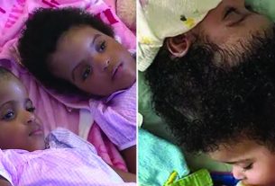 തലയോട്ടി പരസ്പരം ഒട്ടിച്ചേര്ന്ന സയാമിസ് ഇരട്ടകളെ വിജയകരമായി വേര്പെടുത്തി