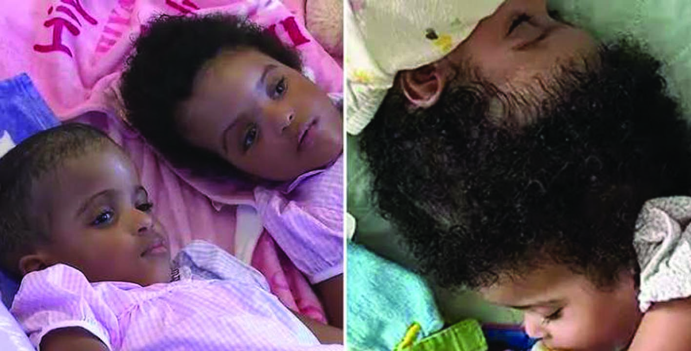 തലയോട്ടി പരസ്പരം ഒട്ടിച്ചേര്‍ന്ന സയാമിസ് ഇരട്ടകളെ വിജയകരമായി വേര്‍പെടുത്തി